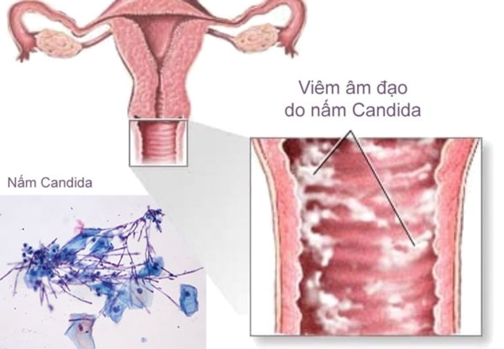 Nấm candida có nguy hiểm không là thắc mắc của nhiều chị em