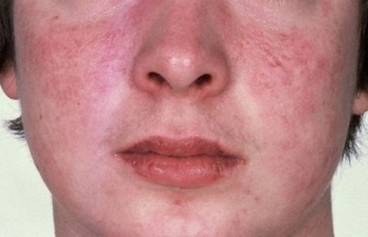 Bệnh nhân bị lupus ban đỏ cần được khám và điều trị sớm