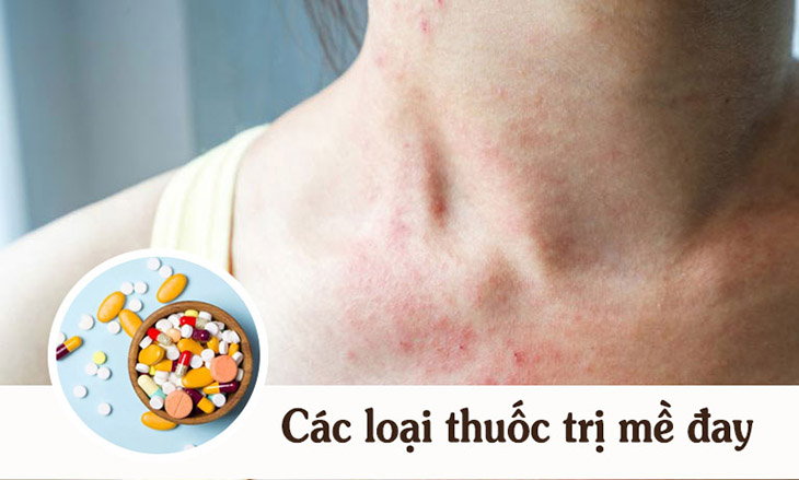 Sử dụng thuốc Tây y để trị chứng nổi mề đay hiệu quả