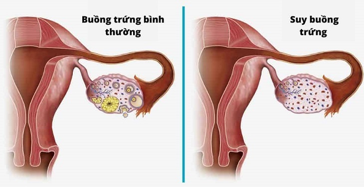 Buồng trứng suy giảm là nguyên nhân chủ yếu dẫn đến rối loạn kinh nguyệt tiền mãn kinh