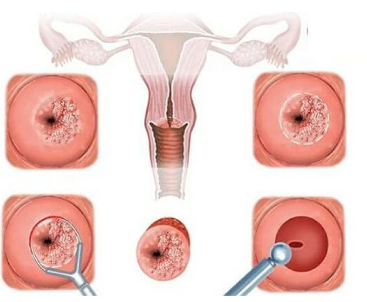 Rong kinh 1 tháng là dấu hiệu cảnh báo các bệnh lý phụ khoa nguy hiểm