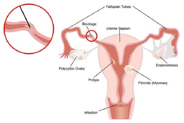 Thông tắc vòi trứng hết bao nhiêu tiền phụ thuộc vào nhiều yếu tố khác nhau