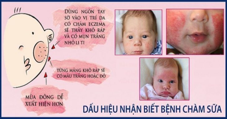 Chàm sữa rất dễ nhận diện