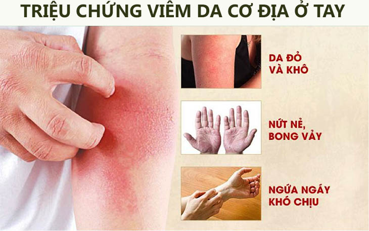 Triệu chứng thường gặp khi bị viêm da cơ địa ở tay