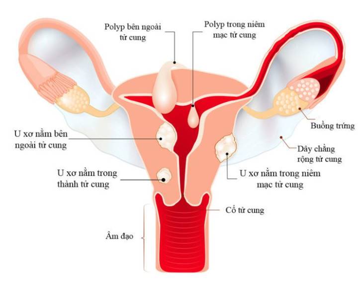 Tác dụng nổi bật của trinh nữ hoàng cung là điều trị hiệu quả u xơ tử cung