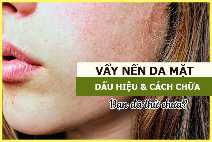 Vảy nến da mặt ảnh hưởng thẩm mỹ khiến người bệnh mất tự tin khi giao tiếp