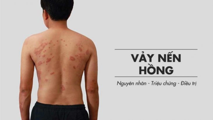 Vảy phấn hồng là bệnh lý thường gặp