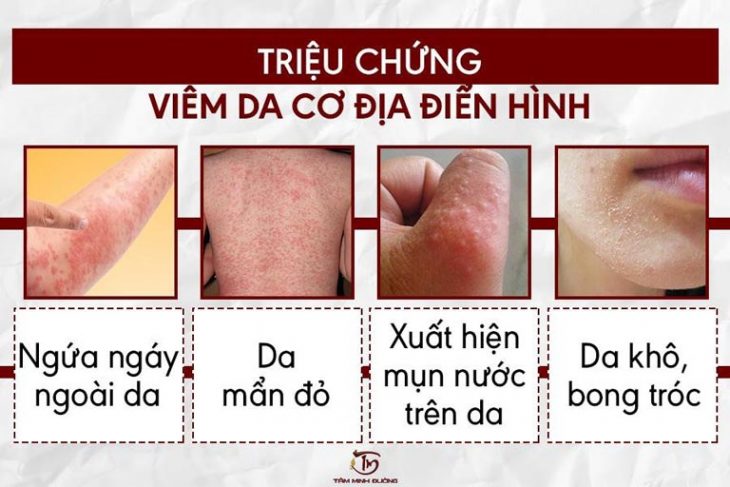 Một số triệu chứng điển hình mà viêm da cơ địa gây ra ở người lớn