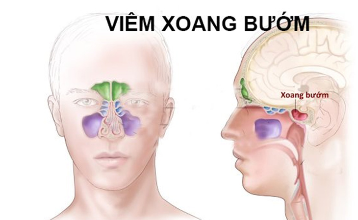 Hình ảnh viêm xoang bướm