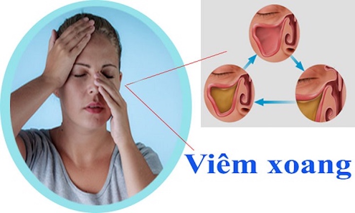 Viêm xoang cấp mủ là biến chứng của viêm xoang cấp tính