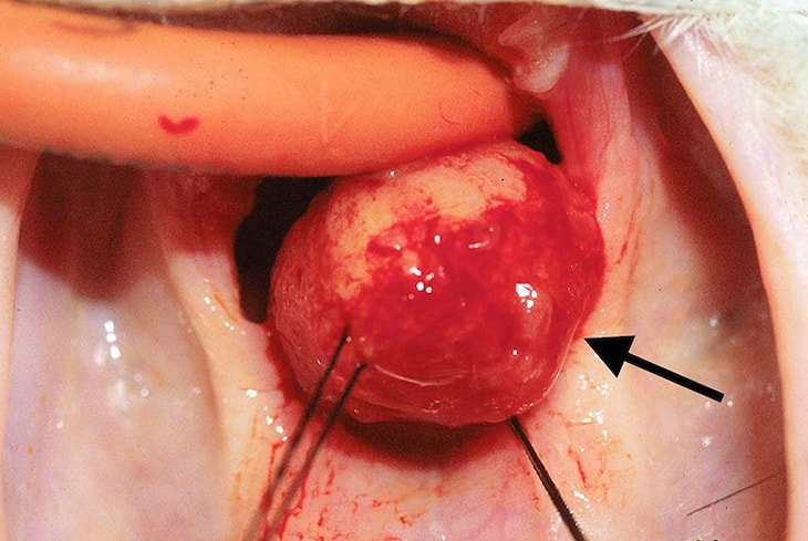 Phẫu thuật nhằm loại bỏ khối Polyp kích thước lớn