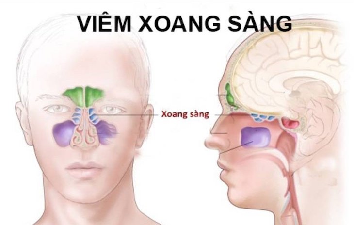 Viêm xoang sau mãn tính là bệnh lý phổ biến khá nguy hiểm