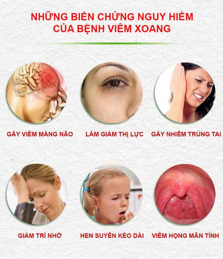 Viêm xoang sau mãn tính gây nhiều biến chứng nguy hiểm