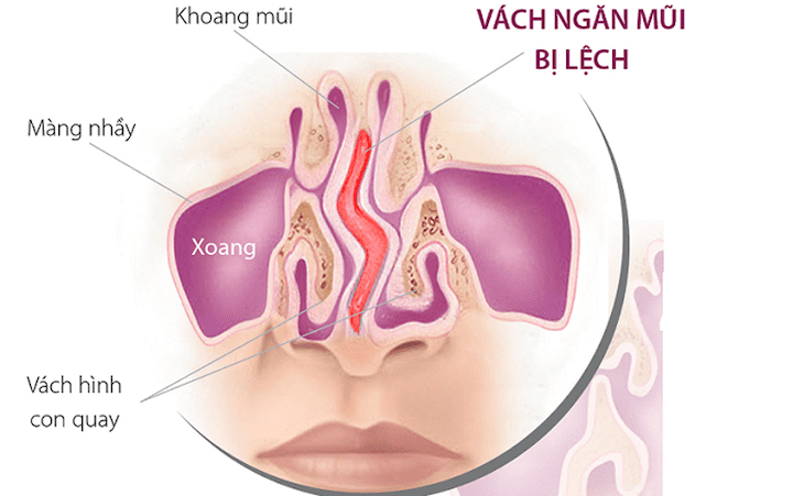 Lệch vách ngăn mũi cũng là yếu tố hình thành bệnh