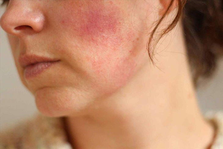 Acnes Scar Care có thể gây ửng đỏ tại vị trí bôi thuốc đối với những làn da nhạy cảm