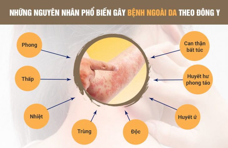 Theo Đông y, có rất nhiều nguyên nhân gây ra bệnh ngoài da