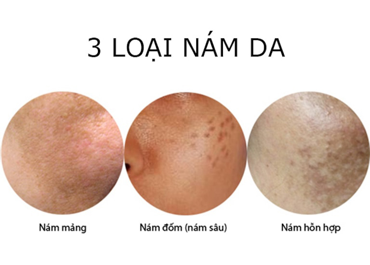 Nám da mặt được chia ra làm 3 dạng phổ biến