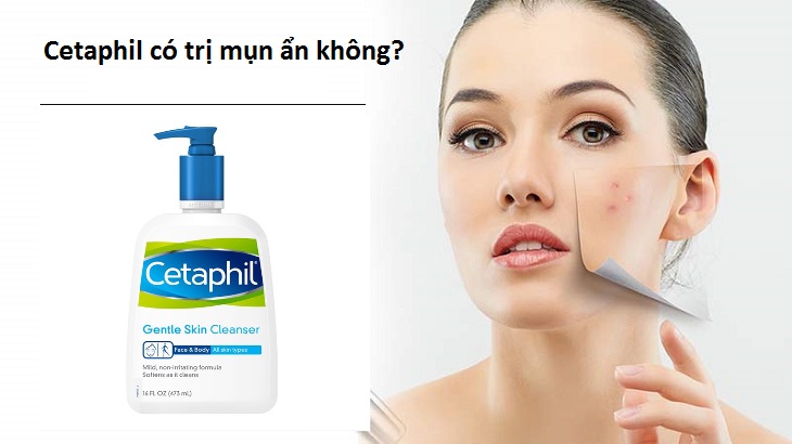 Cetaphil có trị mụn ẩn không?