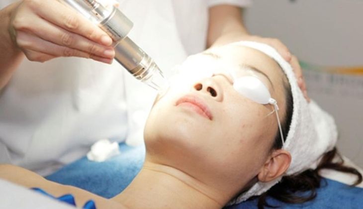 Các bước điều trị thâm mụn bằng laser