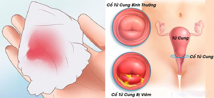 Huyết trắng có màu hồng nhạt có thể là biểu hiện của viêm cổ tử cung