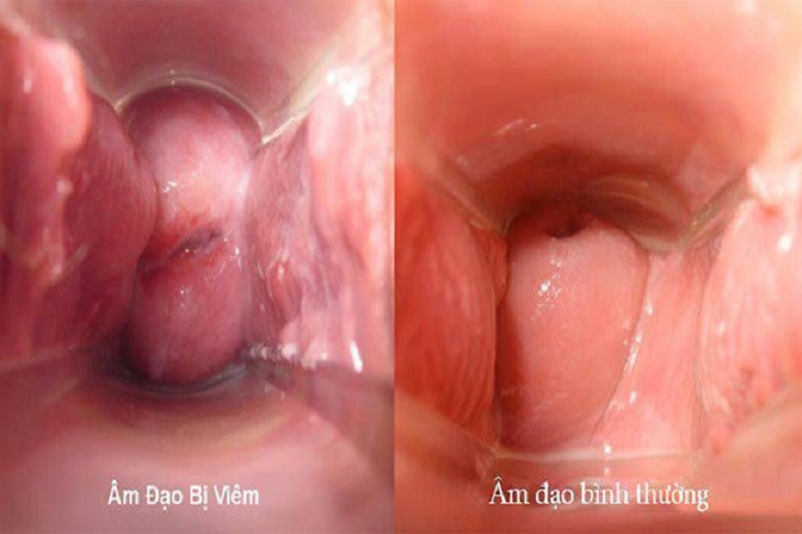 Viêm âm đạo là một nguyên nhân gây ra khí hư màu nâu đỏ giữa chu kỳ