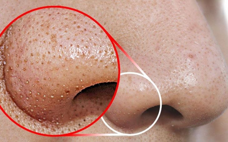 Kem trị mụn La Roche Posay điều trị mụn đầu đen hiệu quả