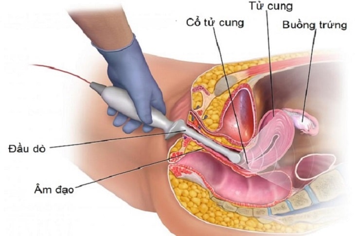 Lạc nội mạc tử cung siêu âm có chính xác không?