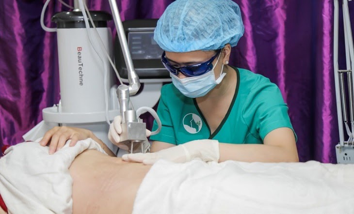 Bác sĩ đang tiến hành xóa rạn da bằng laser