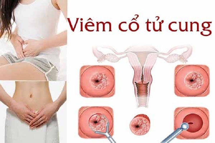 Viêm cổ tử cung là một trong những căn bệnh gây ra khí hư bất thường