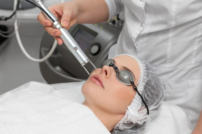 Điều trị sẹo lồi mụn trứng cá bằng bước sóng laser