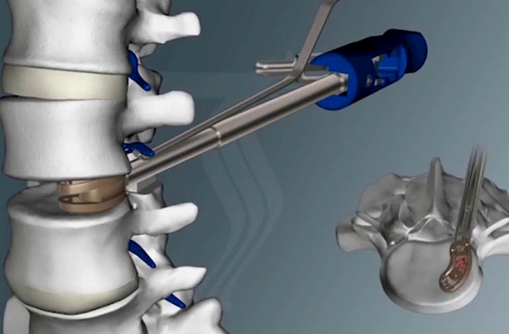Thay đĩa đệm nhân tạo - cách chữa thoát vị đĩa đệm cột sống cổ mới
