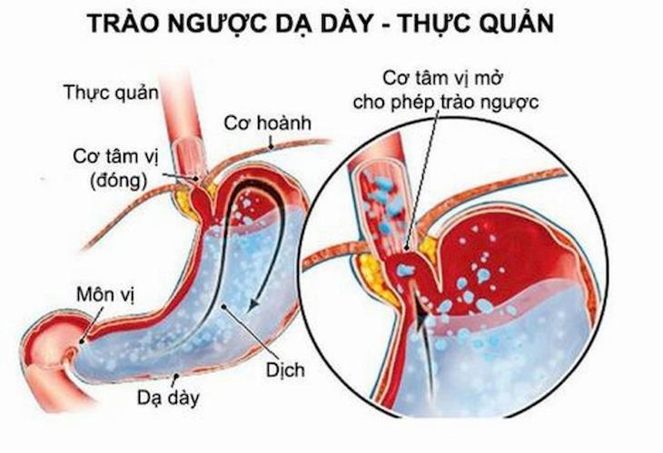 Điều trị trào ngược dạ dày cần tuân thủ đúng nguyên tắc