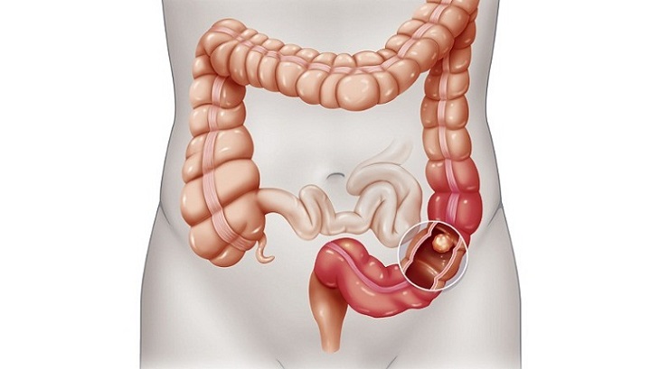 Viêm đại tràng sigma là căn bệnh phổ biến nhất hiện nay