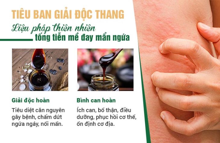 Tiêu ban Giải độc thang kết hợp 2 phép trị dứt điểm mề đay mẩn ngứa