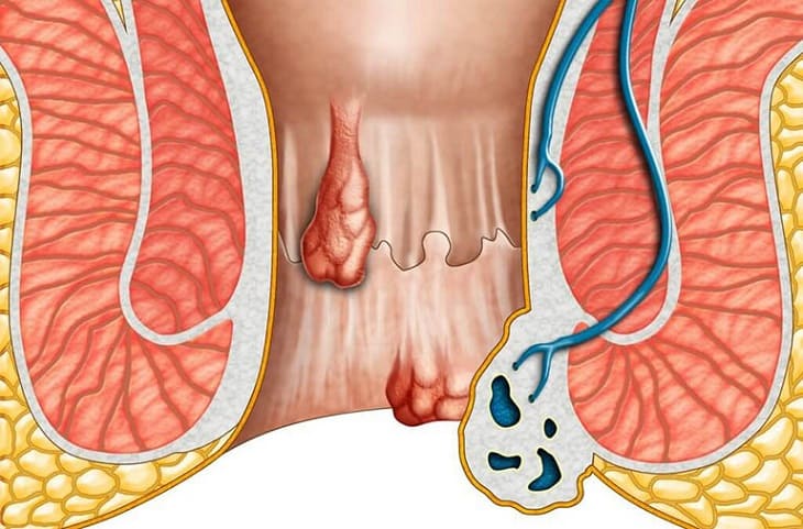 Lòi dom là một bệnh lý về hậu môn - trực tràng khá phổ biến hiện nay