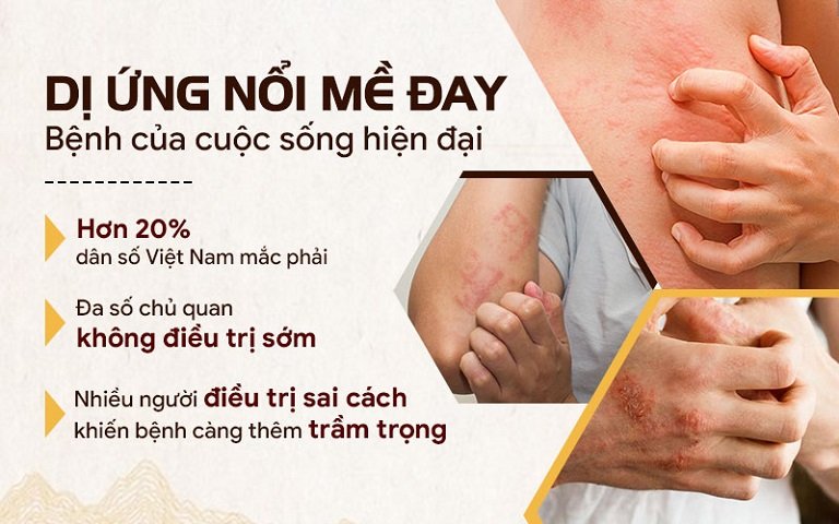 Nổi mề đay là căn bệnh phổ biến, gây ảnh hưởng lớn tới chất lượng cuộc sống