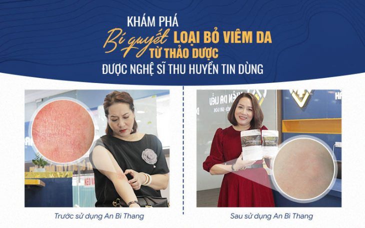 Bài thuốc An Bì Thang chữa viêm da cơ địa đã mang lại sự hài lòng cho nghệ sĩ Thu Huyền