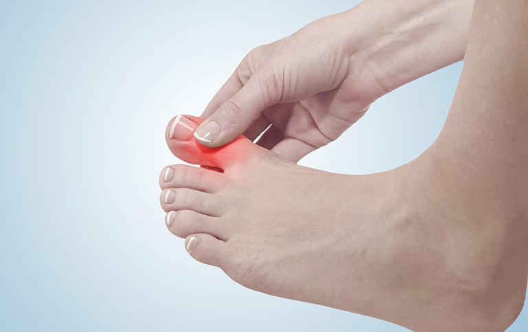 Cô Thanh bị gout nhẹ với triệu chứng đau nhức ngón chân cái