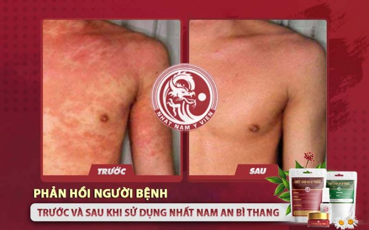 Hình ảnh trước và sau khi sử dụng Nhất Nam An Bì Thang của bệnh nhân