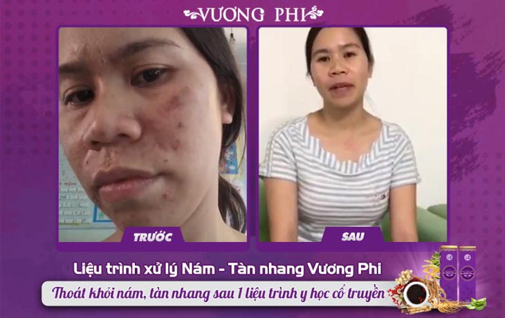 Làn da của chị Nụ thay đổi sau khi dùng Vương Phi