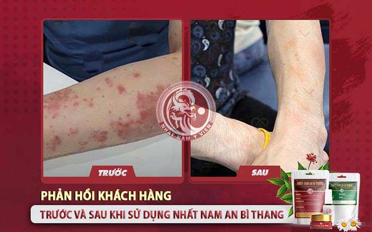 Kết quả điều trị vảy nến sau 1 liệu trình sử dụng Nhất Nam An Bì Thang