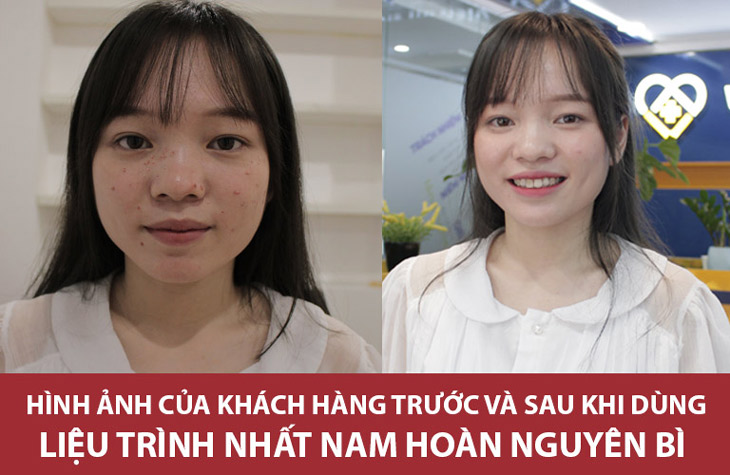 Linh chia sẻ làn da đã sáng đẹp, sạch mụn sau 3 tháng dùng Nhất Nam Hoàn Nguyên Bì